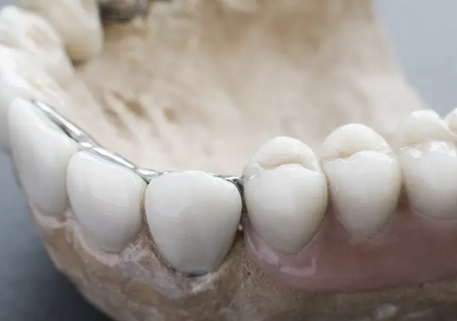 硬質レジン前装冠