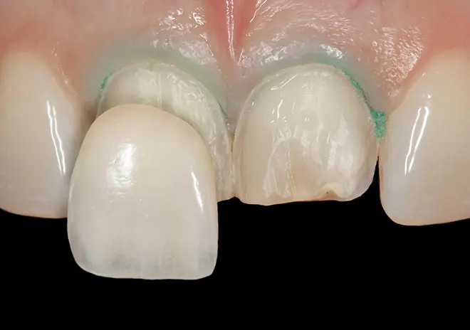 ラミネートベニア