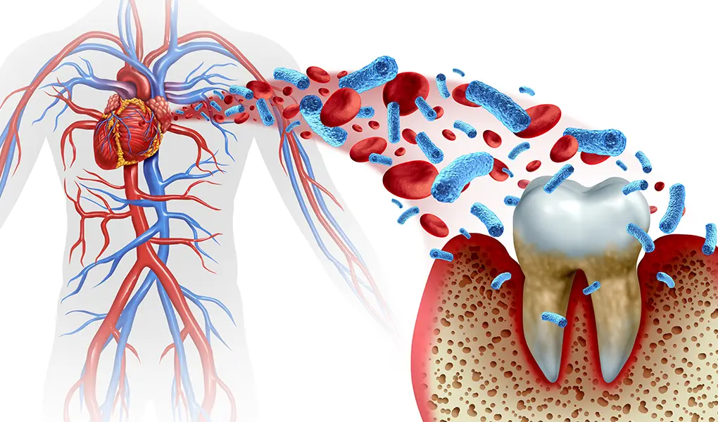 歯周病と全身疾患