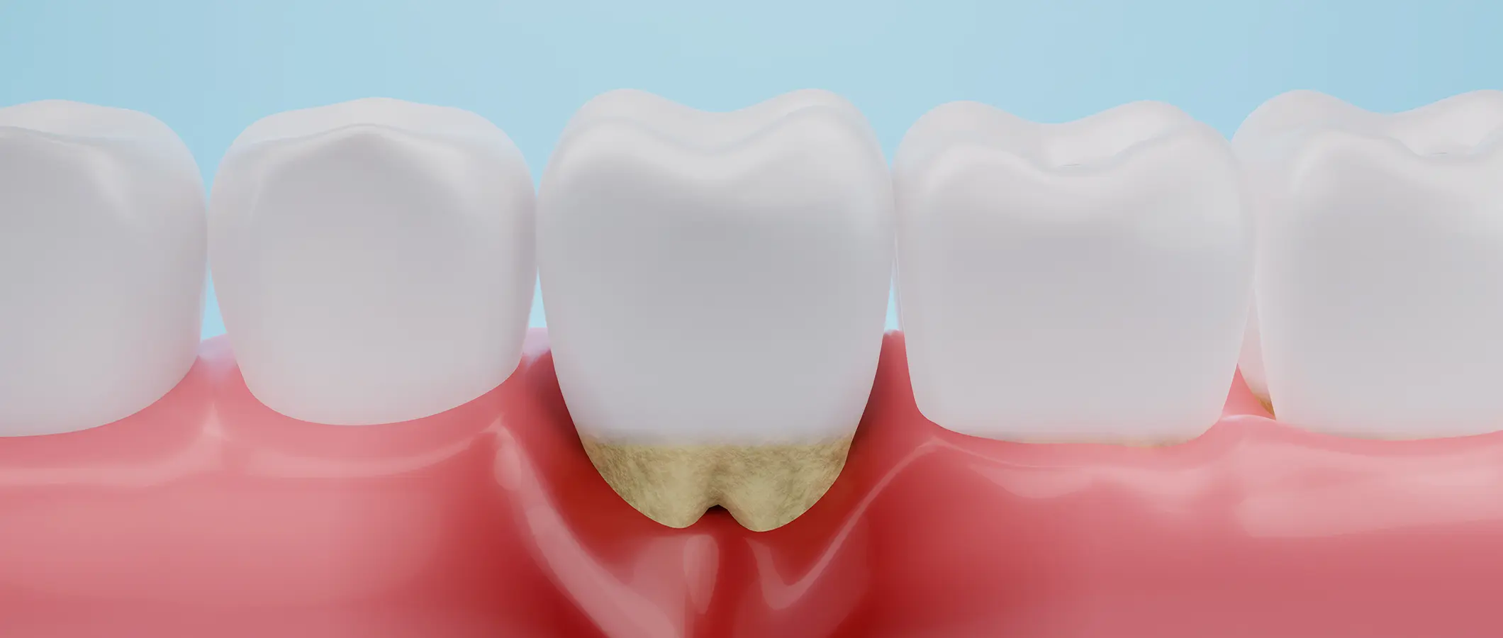 歯周病について