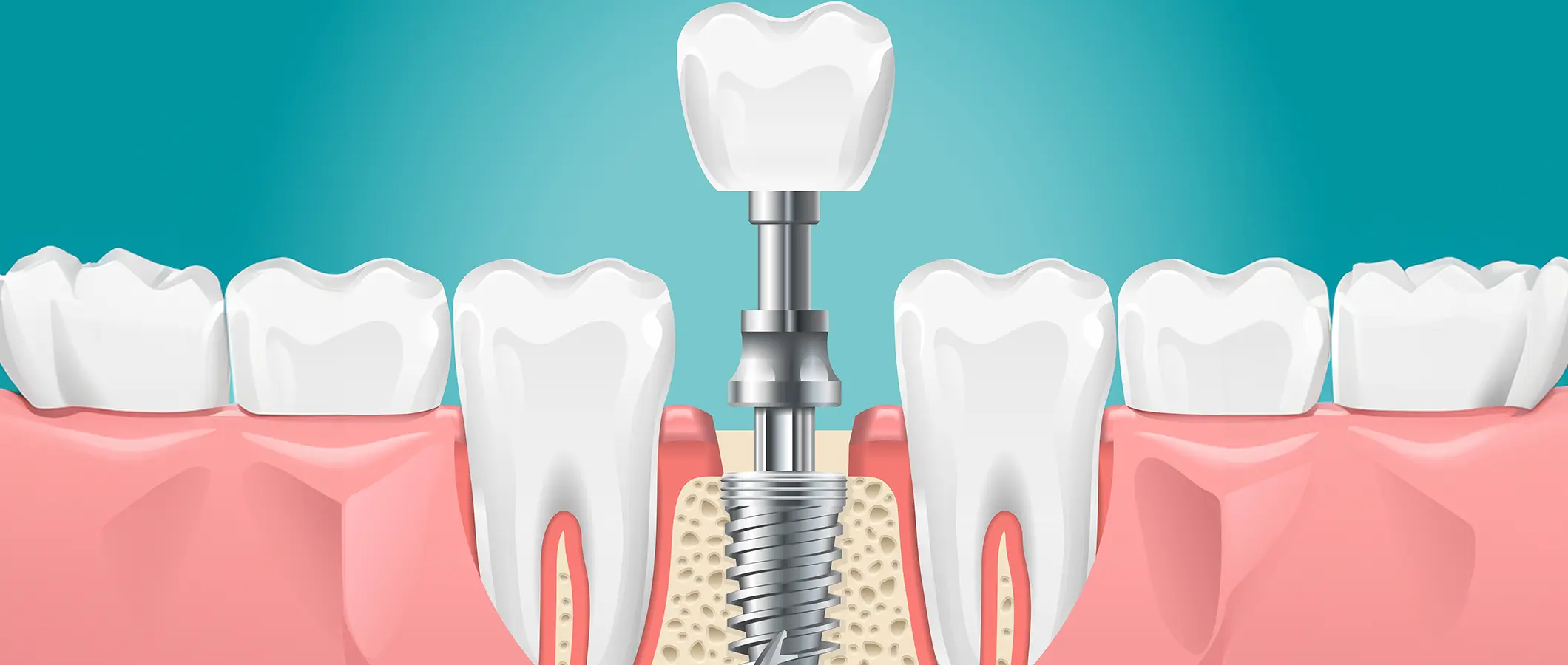 インプラント治療とは