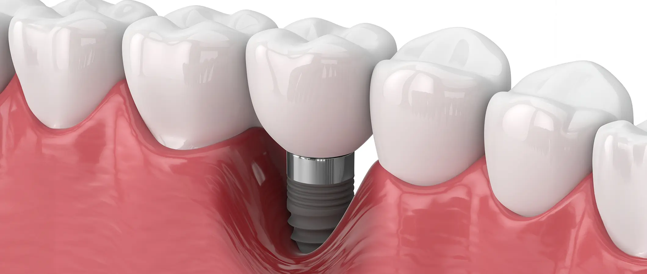 治療後のメンテナンス