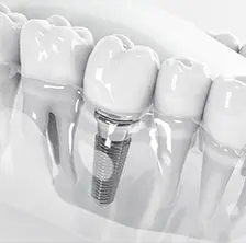 インプラント治療・入れ歯