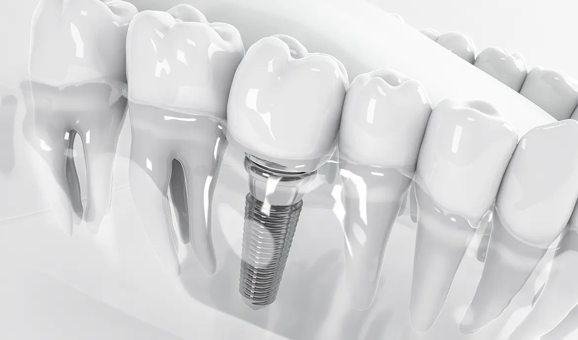 インプラント治療・入れ歯