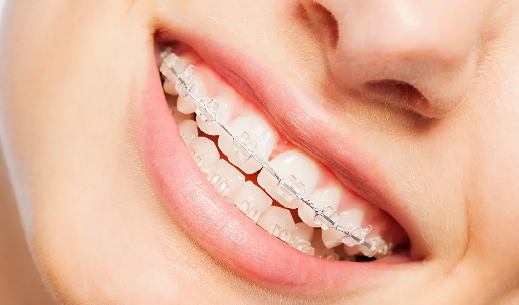 セラミックブラケット（セラミックの矯正装置）