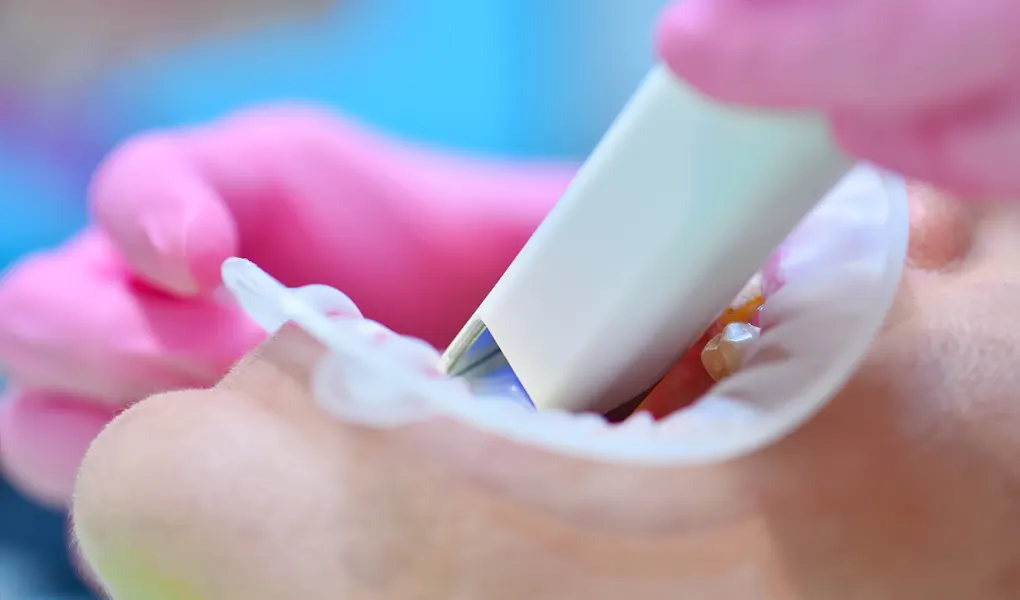 口腔内スキャナー（iTero）