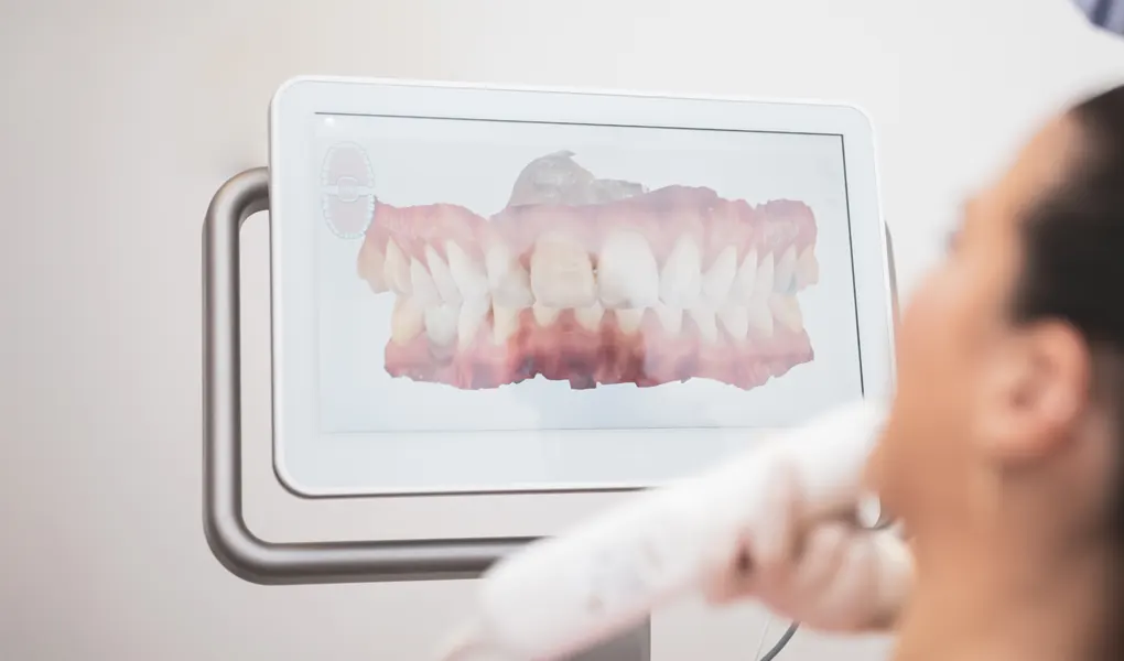 クリンチェック