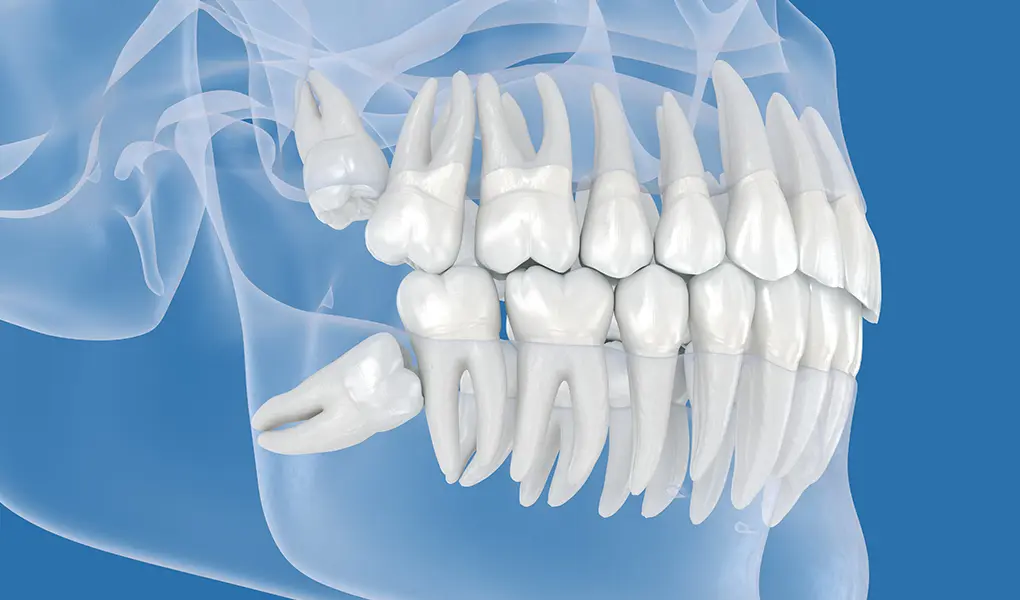 親知らずの抜歯